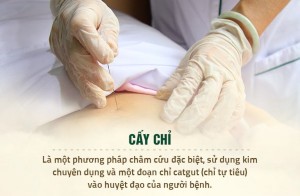 CHÂM CỨU VÀ CẤY CHỈ KHÁC NHAU NHƯ THẾ NÀO?