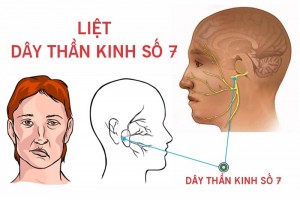 Nguyên nhân khiến nhiều người liệt dây thần kinh số 7 ngoại biên vào mùa đông