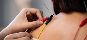 Hiệu quả của phương pháp châm cứu điện châm trong điều trị