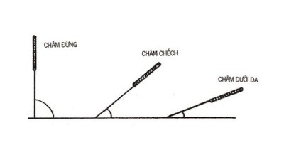 cách cầm kim châm cứu