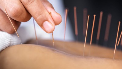 có nên châm cứu liên tục không