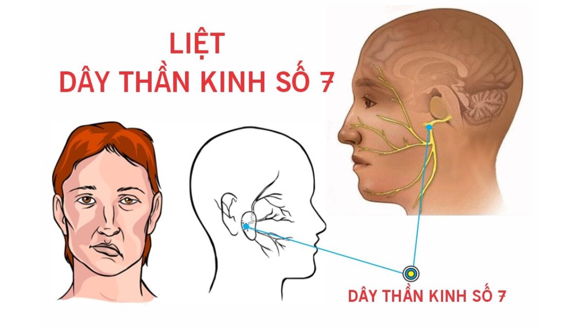 Nguyên nhân gây liệt dây thần kinh số 7 ngoai biên